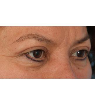 Blepharoplasty after at Facial Plastic Surgeon Winnetka: Dr. Paul Phelps in Winnetka, IL