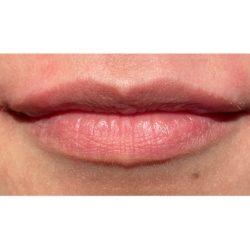 Lip Filler after at Facial Plastic Surgeon Winnetka: Dr. Paul Phelps in Winnetka, IL