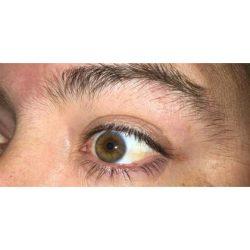 Facial Plastic Surgeon Winnetka: Dr. Paul Phelps blepharoplasty after — Winnetka, IL