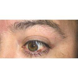 Blepharoplasty before at Facial Plastic Surgeon Winnetka: Dr. Paul Phelps in Winnetka, IL