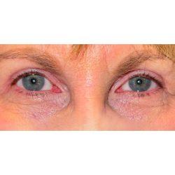 Facial Plastic Surgeon Winnetka: Dr. Paul Phelps blepharoplasty after — Winnetka, IL
