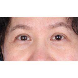 Blepharoplasty after at Facial Plastic Surgeon Winnetka: Dr. Paul Phelps in Winnetka, IL