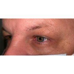 Facial Plastic Surgeon Winnetka: Dr. Paul Phelps after — Winnetka, IL