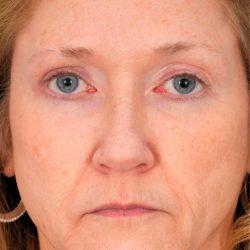 Facial Plastic Surgeon Winnetka: Dr. Paul Phelps blepharoplasty after — Winnetka, IL