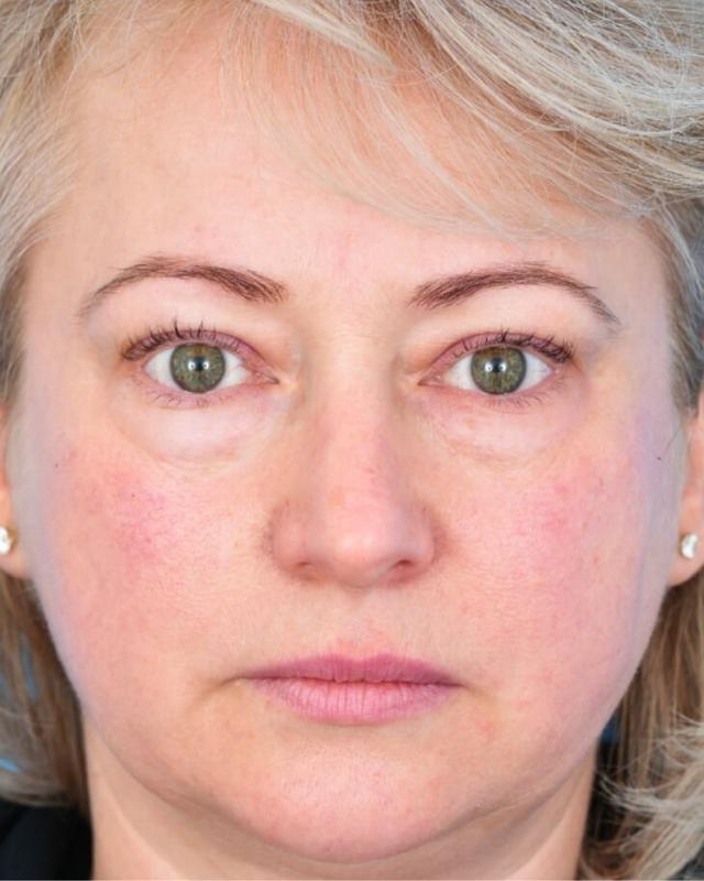 Deep Plane Facelift before at Facial Plastic Surgeon Winnetka: Dr. Paul Phelps in Winnetka, IL