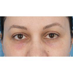 Facial Plastic Surgeon Winnetka: Dr. Paul Phelps after — Winnetka, IL