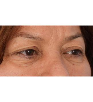 Blepharoplasty before at Facial Plastic Surgeon Winnetka: Dr. Paul Phelps in Winnetka, IL