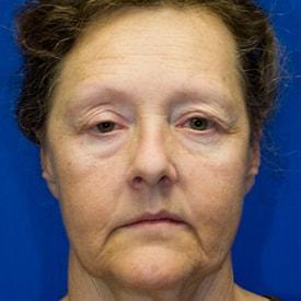 Dermal Fillers before at Lamperti Facial Plastic Surgery in Seattle, WA