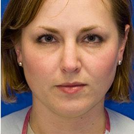 Functional Rhinoplasty after at Lamperti Facial Plastic Surgery in Seattle, WA
