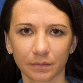 Lamperti Facial Plastic Surgery fat transfer after — Seattle, WA