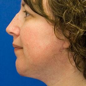 Neck Liposuction after at Lamperti Facial Plastic Surgery in Seattle, WA