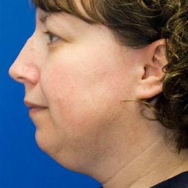Neck Liposuction before at Lamperti Facial Plastic Surgery in Seattle, WA