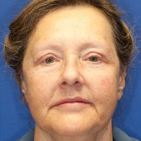 Dermal Fillers after at Lamperti Facial Plastic Surgery in Seattle, WA