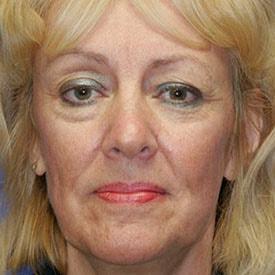 Laser Skin Resurfacing before at Lamperti Facial Plastic Surgery in Seattle, WA