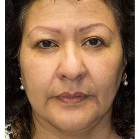Lamperti Facial Plastic Surgery fat transfer after — Seattle, WA