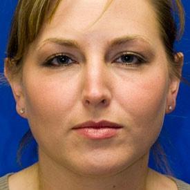 Functional Rhinoplasty before at Lamperti Facial Plastic Surgery in Seattle, WA