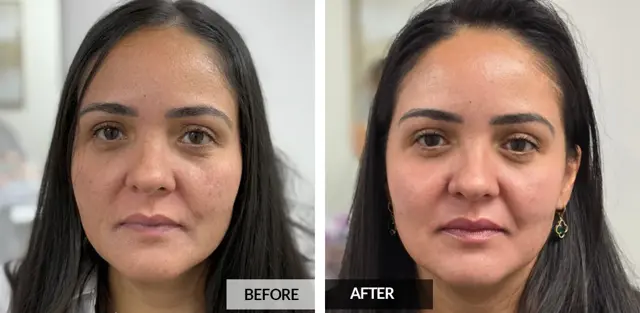 Botox result at Pele Aesthetics in Marietta, GA
