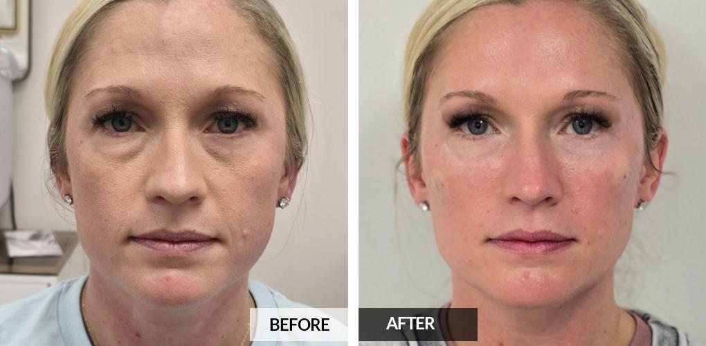 Pele Aesthetics result — Marietta, GA
