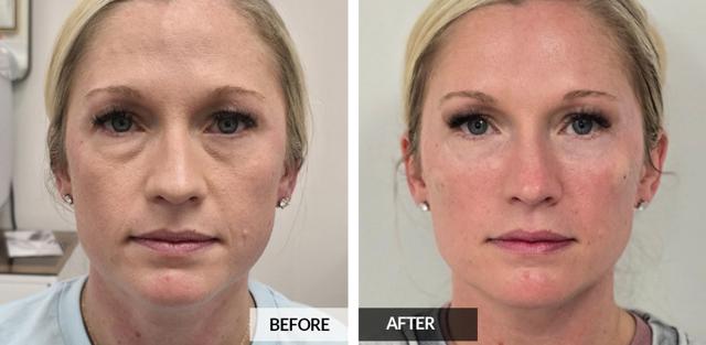 Blepharoplasty result at Pele Aesthetics in Marietta, GA