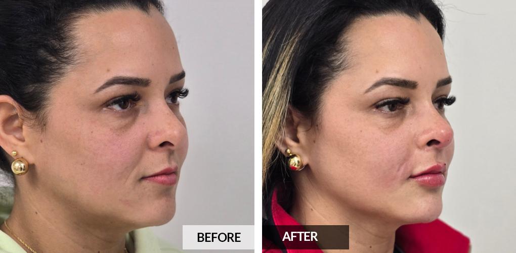 Pele Aesthetics lip filler result — Marietta, GA