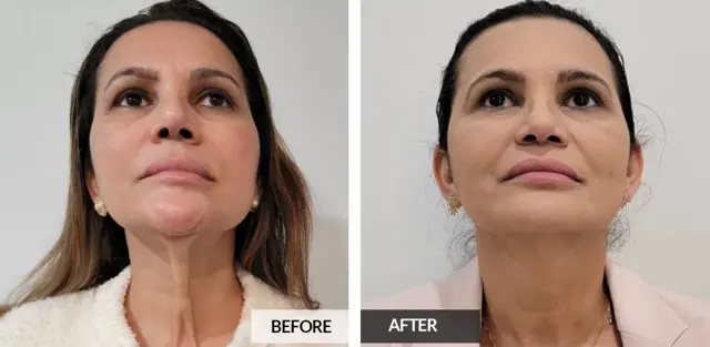 Botox result at Pele Aesthetics in Marietta, GA