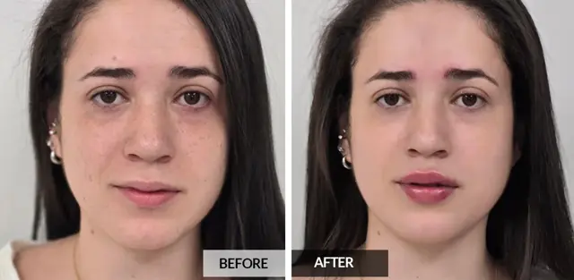 Botox result at Pele Aesthetics in Marietta, GA