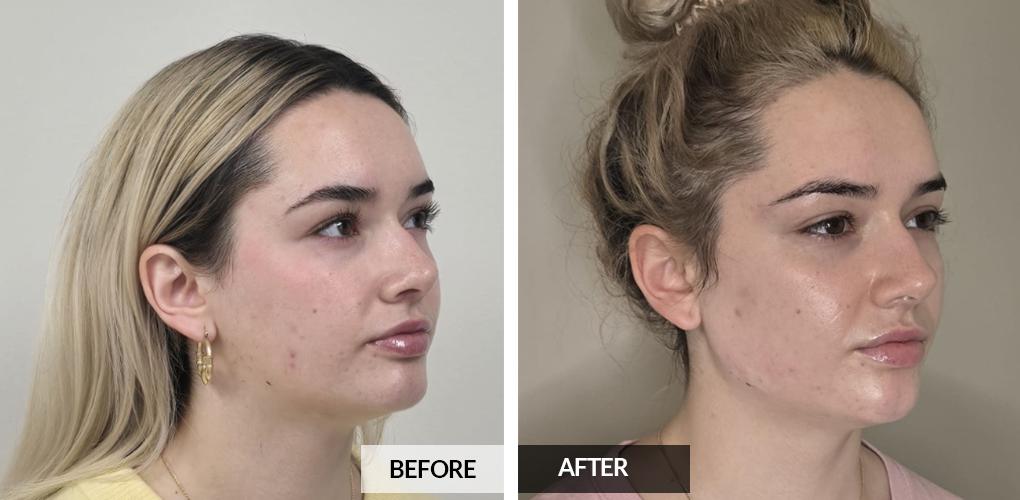 Pele Aesthetics result — Marietta, GA