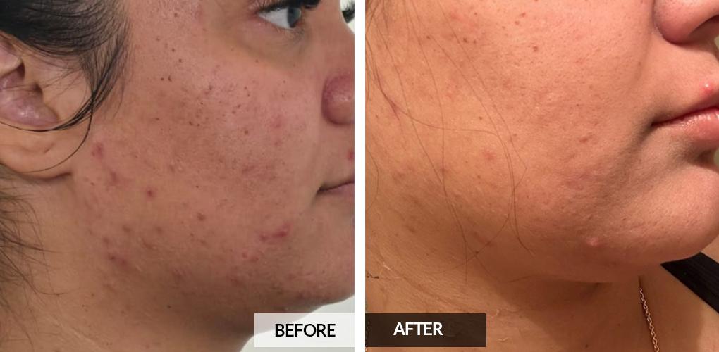 Pele Aesthetics chemical peel result — Marietta, GA