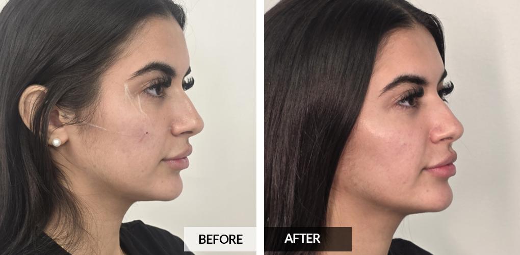 Pele Aesthetics result — Marietta, GA