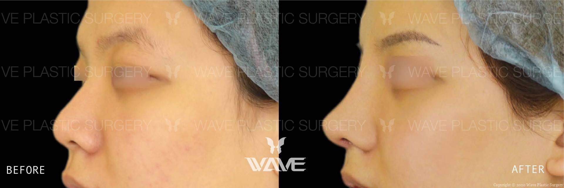 Wave Plastic Surgery rhinoplasty result — Los Angeles, CA