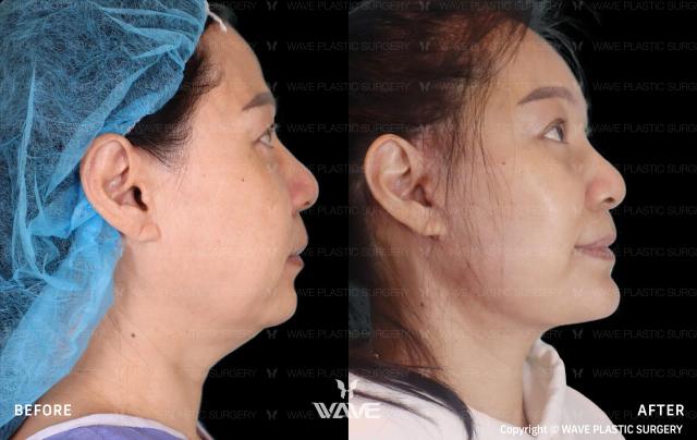 Facelift result at Wave Plastic Surgery in Los Angeles, CA