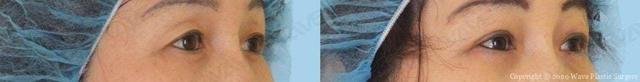 Blepharoplasty result at Wave Plastic Surgery in Los Angeles, CA