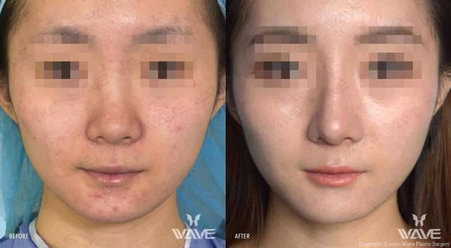 Rhinoplasty result at Wave Plastic Surgery in Los Angeles, CA