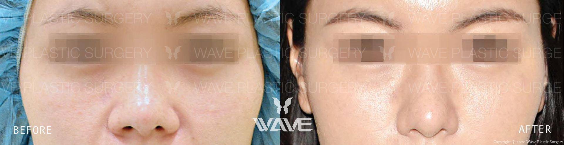Wave Plastic Surgery rhinoplasty result — Los Angeles, CA