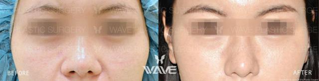Functional Rhinoplasty result at Wave Plastic Surgery in Los Angeles, CA