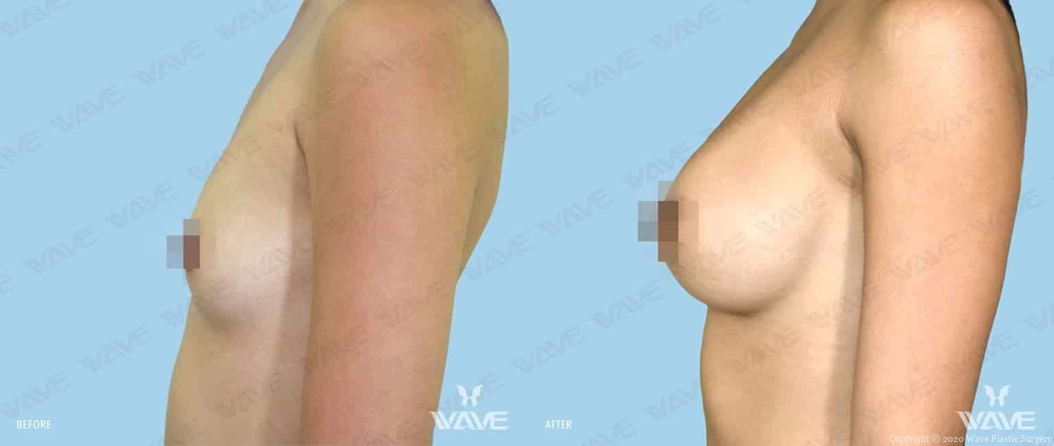 Wave Plastic Surgery breast augmentation result — Los Angeles, CA