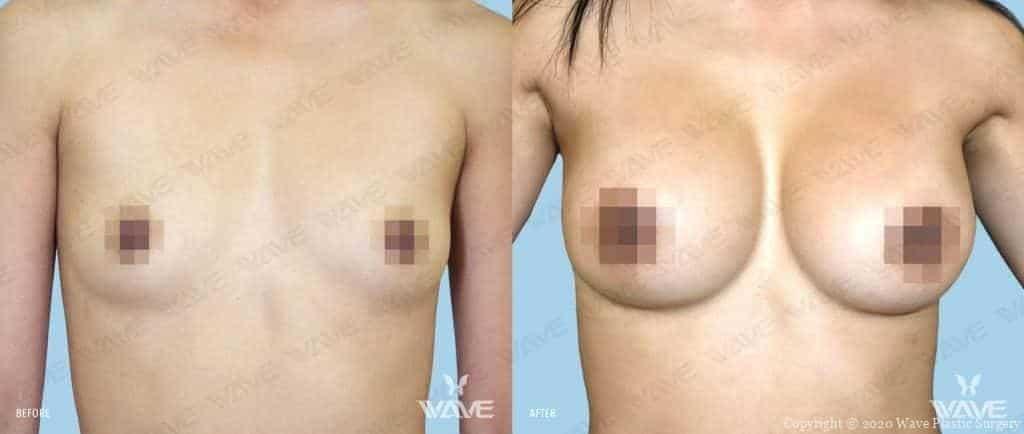 Wave Plastic Surgery breast augmentation result — Los Angeles, CA