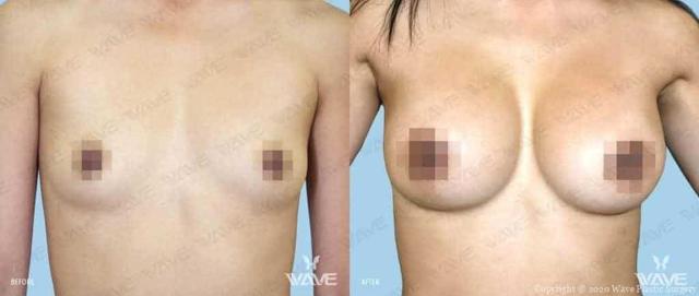Fat Transfer Breast Augmentation result at Wave Plastic Surgery in Los Angeles, CA