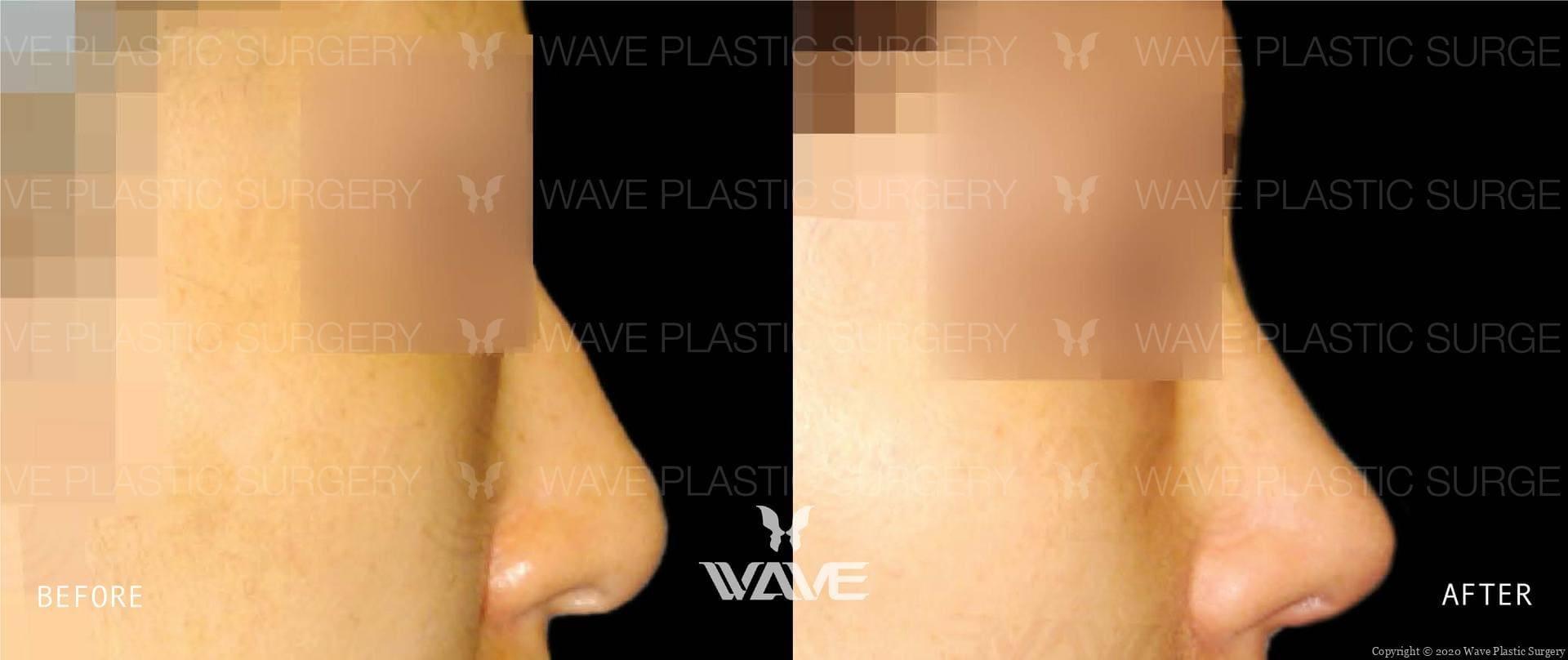 Wave Plastic Surgery rhinoplasty result — Los Angeles, CA