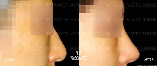 Functional Rhinoplasty result at Wave Plastic Surgery in Los Angeles, CA