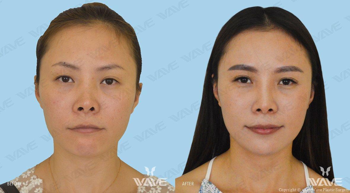 Wave Plastic Surgery rhinoplasty result — Los Angeles, CA