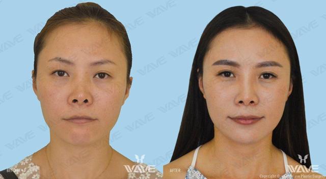 Rhinoplasty result at Wave Plastic Surgery in Los Angeles, CA