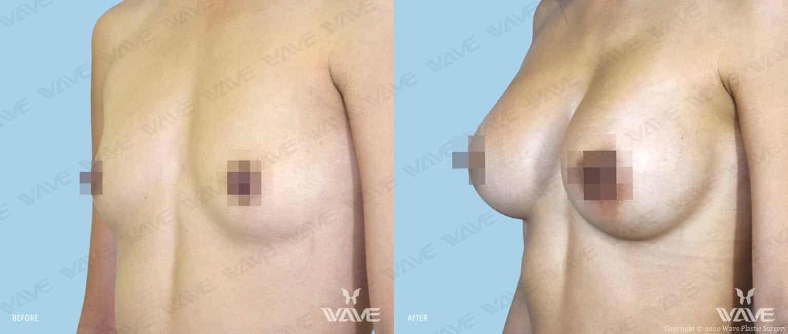 Wave Plastic Surgery breast augmentation result — Los Angeles, CA