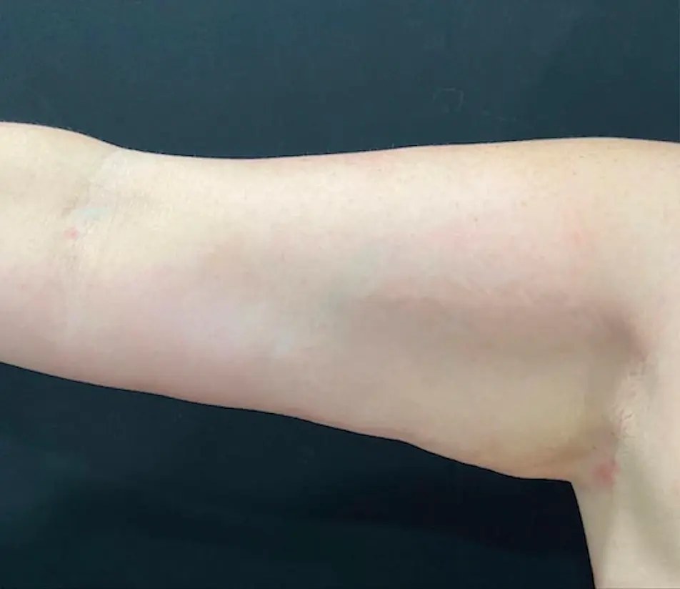 SOMA Cosmetic Surgery & Aesthetics liposuction after — Clive, IA