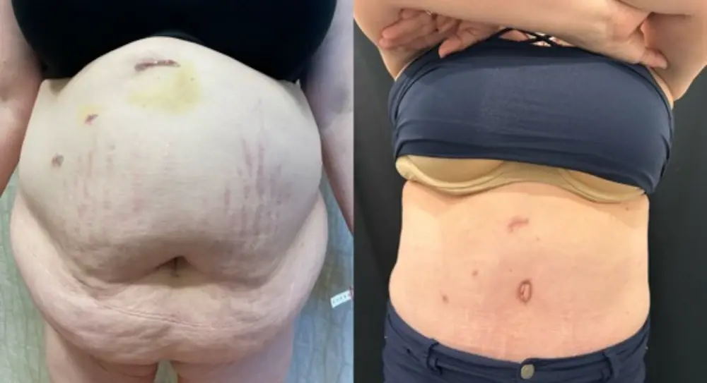 SOMA Cosmetic Surgery & Aesthetics tummy tuck result — Clive, IA
