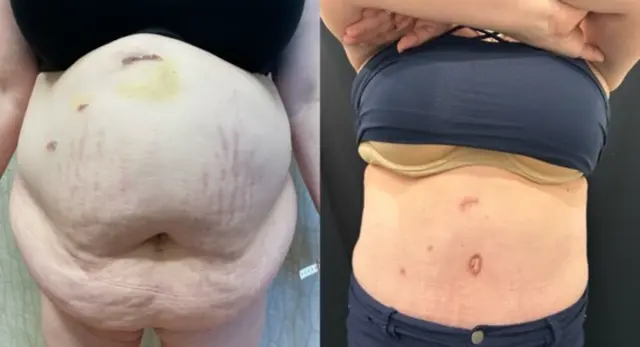 Tummy Tuck result at SOMA Cosmetic Surgery & Aesthetics in Clive, IA