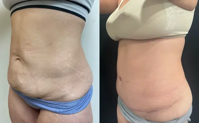 Tummy Tuck result at SOMA Cosmetic Surgery & Aesthetics in Clive, IA