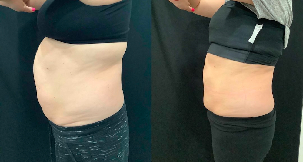 SOMA Cosmetic Surgery & Aesthetics result — Clive, IA