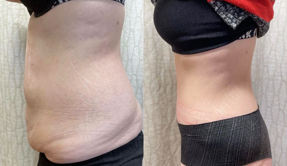 SOMA Cosmetic Surgery & Aesthetics result — Clive, IA