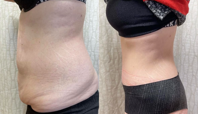 Tummy Tuck result at SOMA Cosmetic Surgery & Aesthetics in Clive, IA